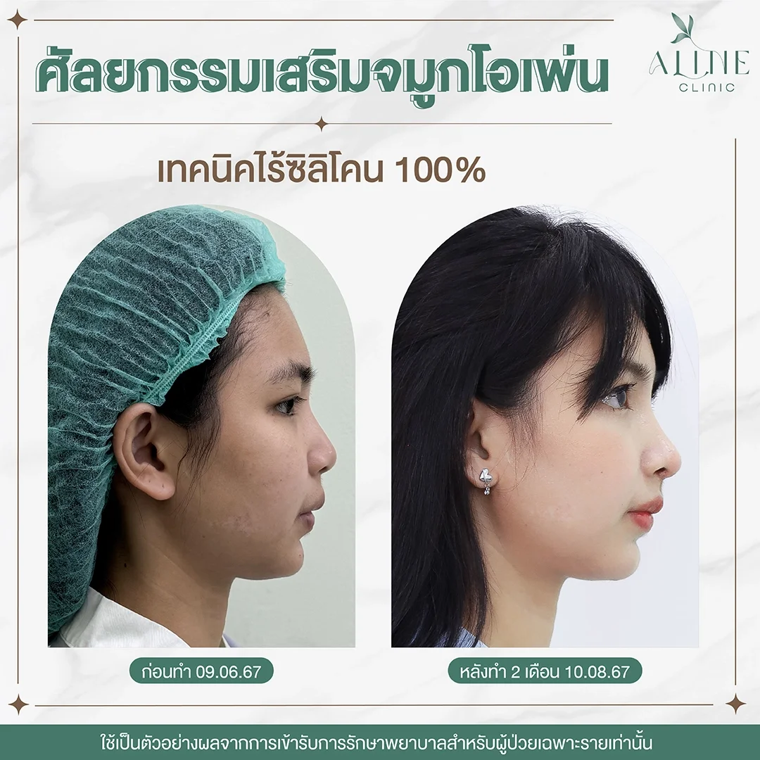 รีวิวเสริมจมูกเทคนิค